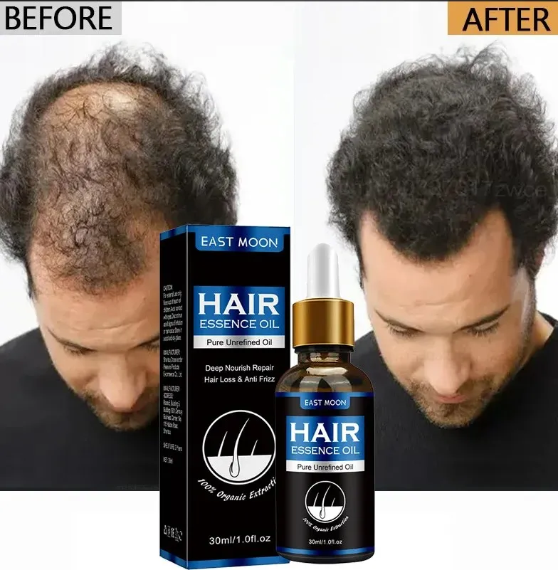 Hair Growth Oil Fast Hair Growth Effective Baldness Repair Hereditary Hair Loss Postpartum Hair Loss Seborrheic Hair Loss Care