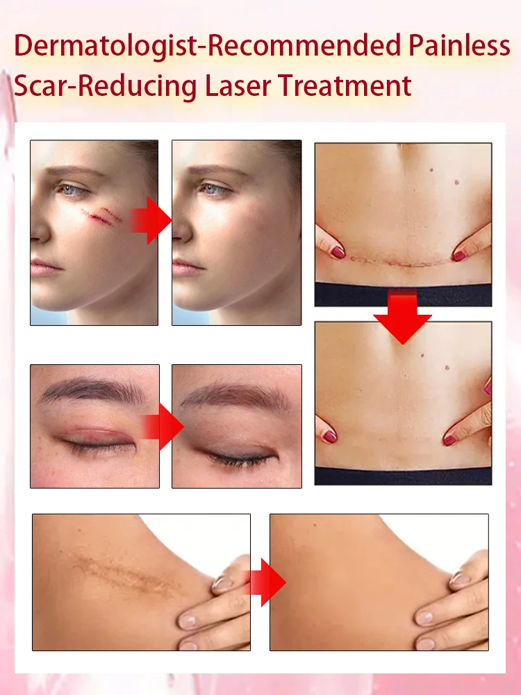 laser repair scar hot sale