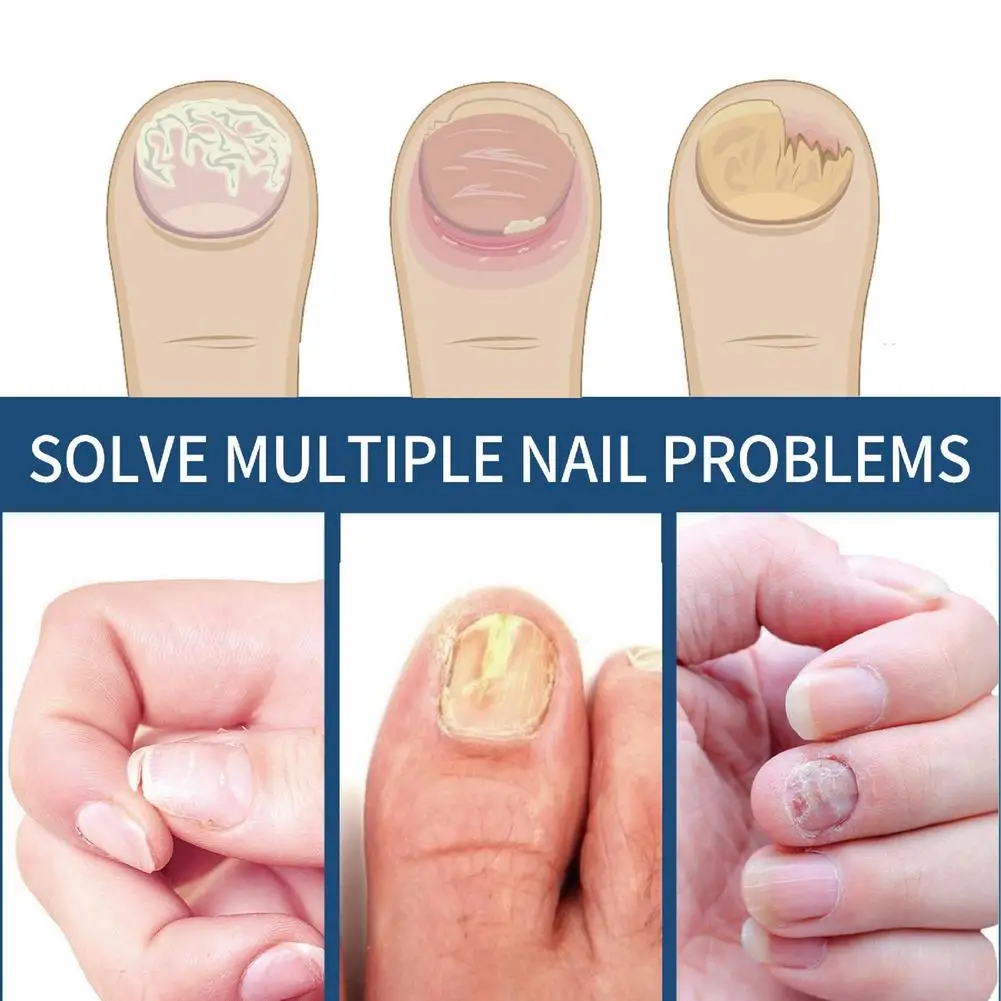12//3箱 真菌性爪パッチ 爪真菌治療 強力夜間ネイルケア ダメージネイル修復 足ケアツール