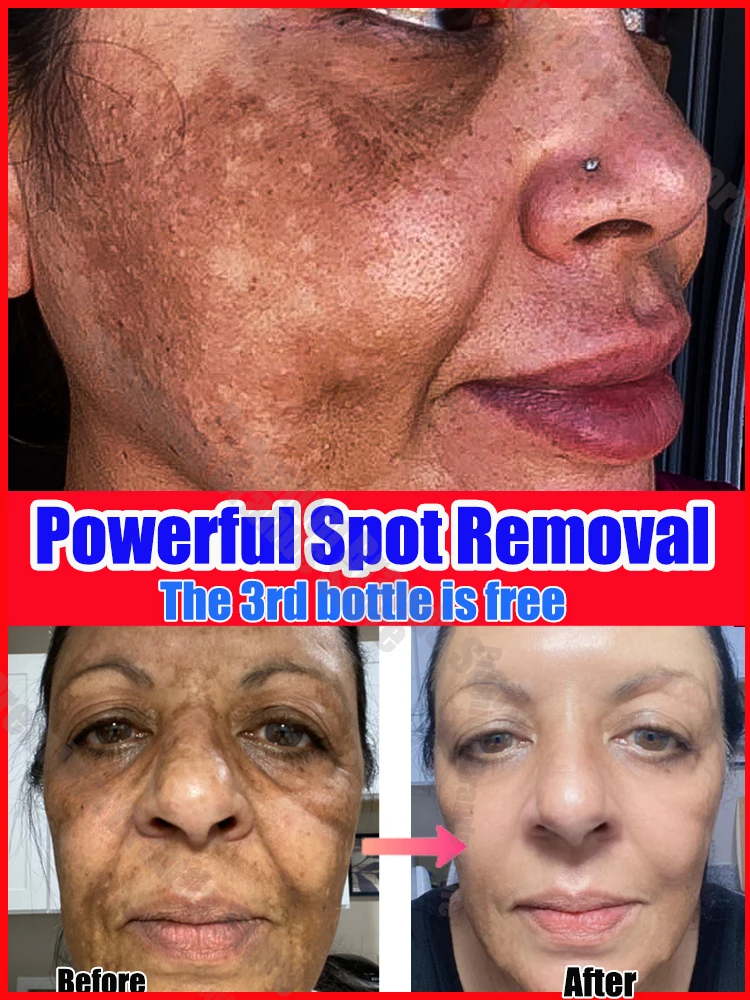 

Dark Spot Remover For Face Melasma Black Spots Cream