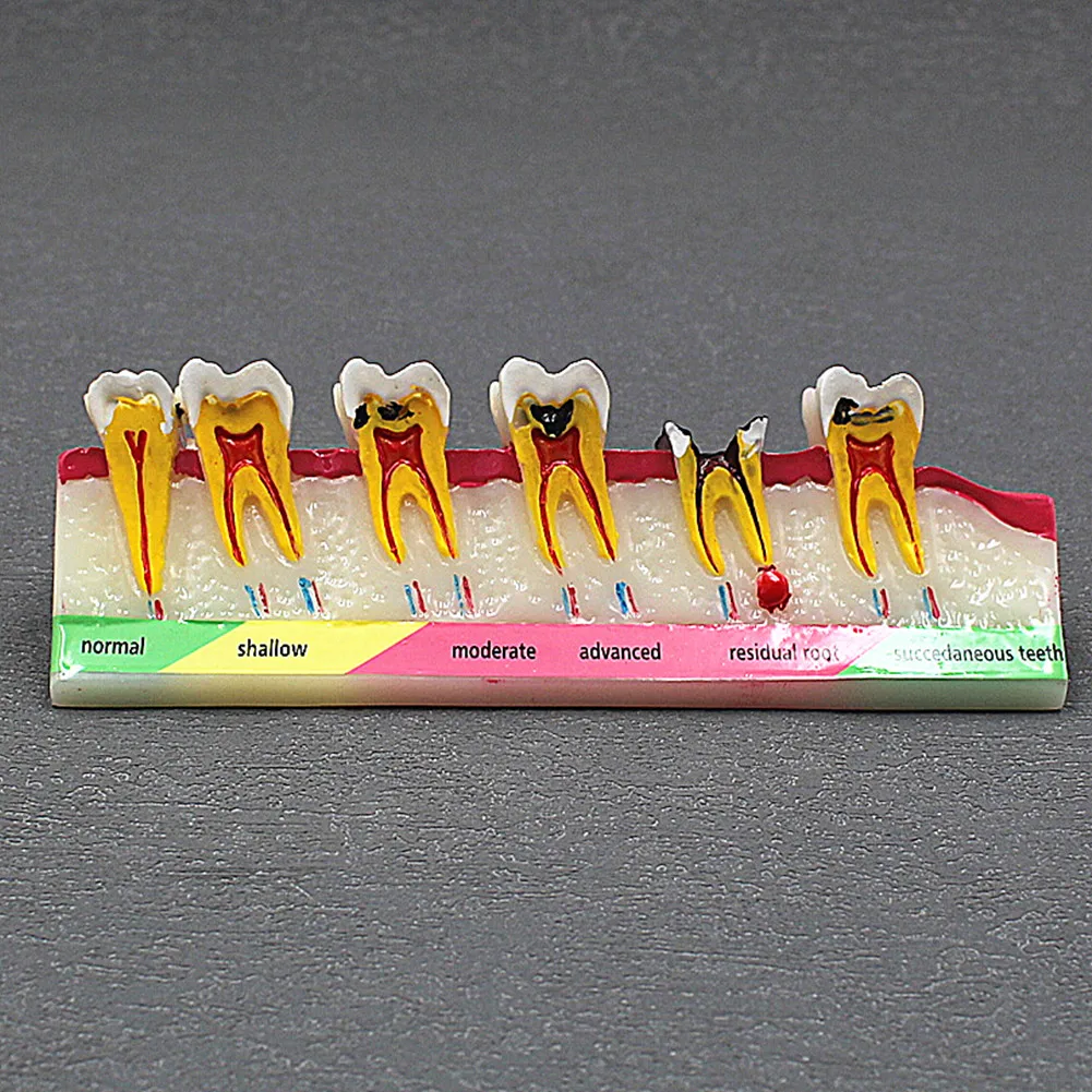 Dental Periodontal Disease Model Caries Fault Display Teaching Periodontal Model Dental Patient Communication