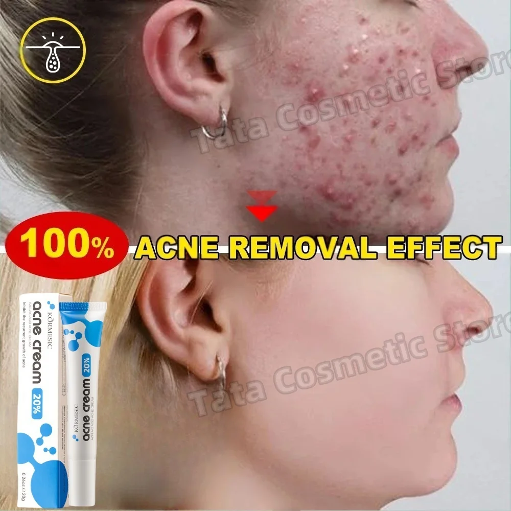 

Anti-Acne Gel Acne Treatment Face Cream Repair Pimple Spots Deep Cleaning Pore Anti-acne Scar Oil Control Moisturizer Skin Care