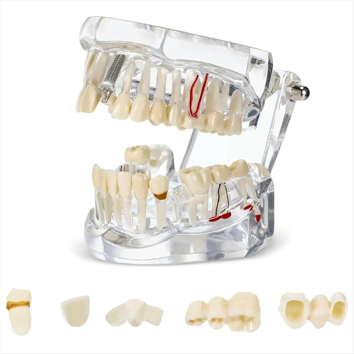 ABJS Disease Teeth Model Dental Typodonts Implant Teeth Model with Removable Teeth Dentist Standard Tooth Demonstration