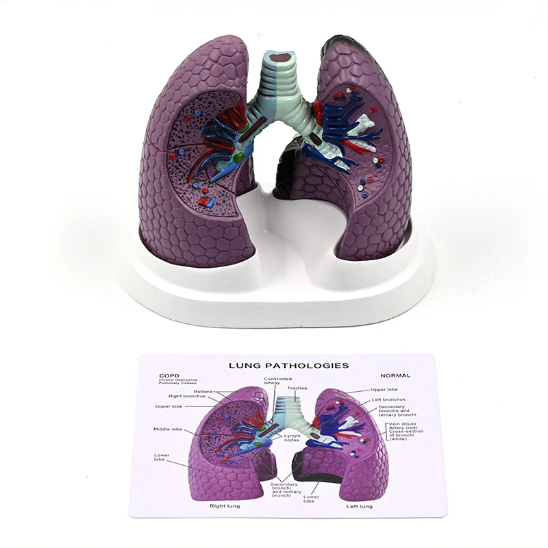 

Human Anatomical Lung Model Normal and Pathological Lung Anatomy Model for Clinical Settings Teaching and Lecture Report
