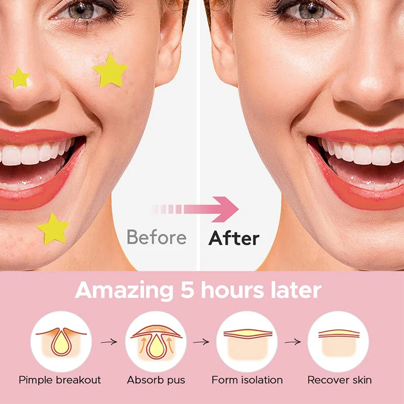 600 PCS/SET Star Pimple Patch Acne Colorful Invisible Acne Removal Skin Care Stickers Concealer Face Spot Beauty Makeup Tools