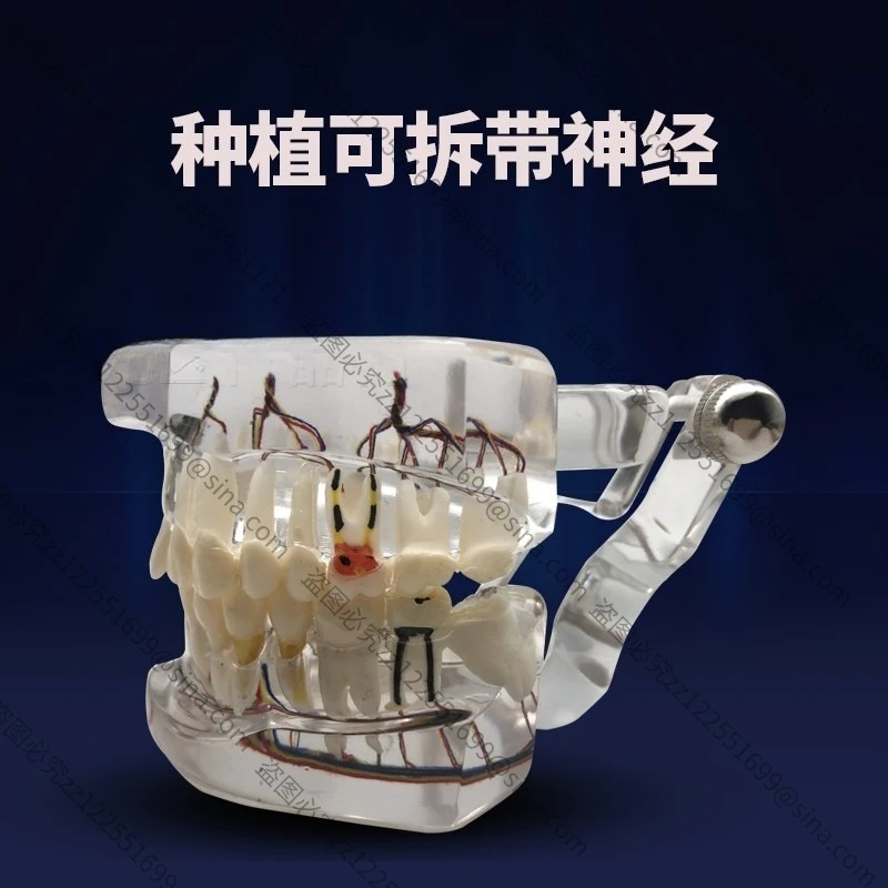 Suitable for Teaching Model Detachable Teaching Ready Denture Model Ornament