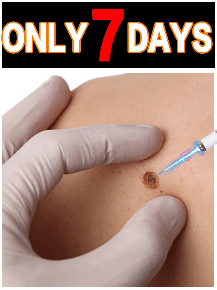 

Blue light pen quickly removes warts, a best-selling wart care tool.