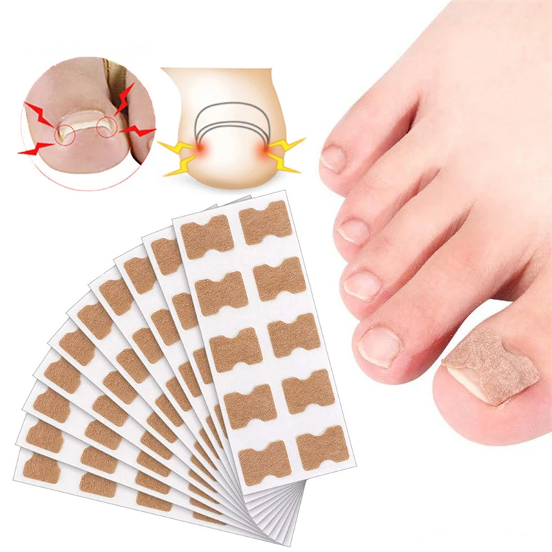 10/20 Stuks Ingegroeide Teennagel Correctie Stickers Teennagel Corrector Patch Grote Teen Nagel Corrector Patch