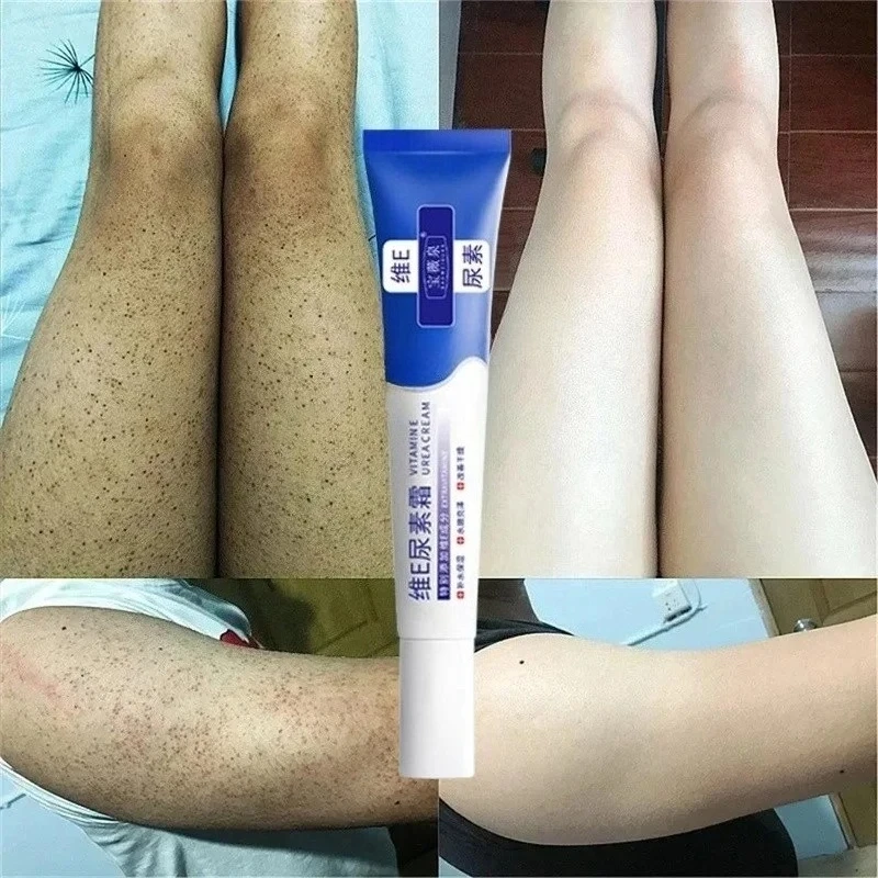 Curing Keratosis Pilaris Chicken Follicle Skin Repair Cream Body Dark Spot Remove Whitening Smooth Moisturize Skincare Body