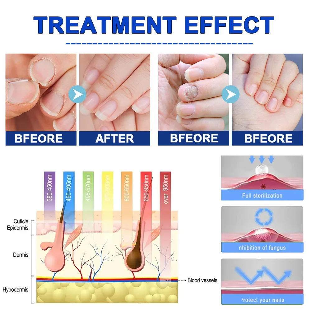 Dispositivo de tratamento do fungo do prego, Unhas do pé, Soro de reparação fúngica, Anti infecção, Unhas cinzentas, Onicomicose, Paroníquia Remover Ferramentas