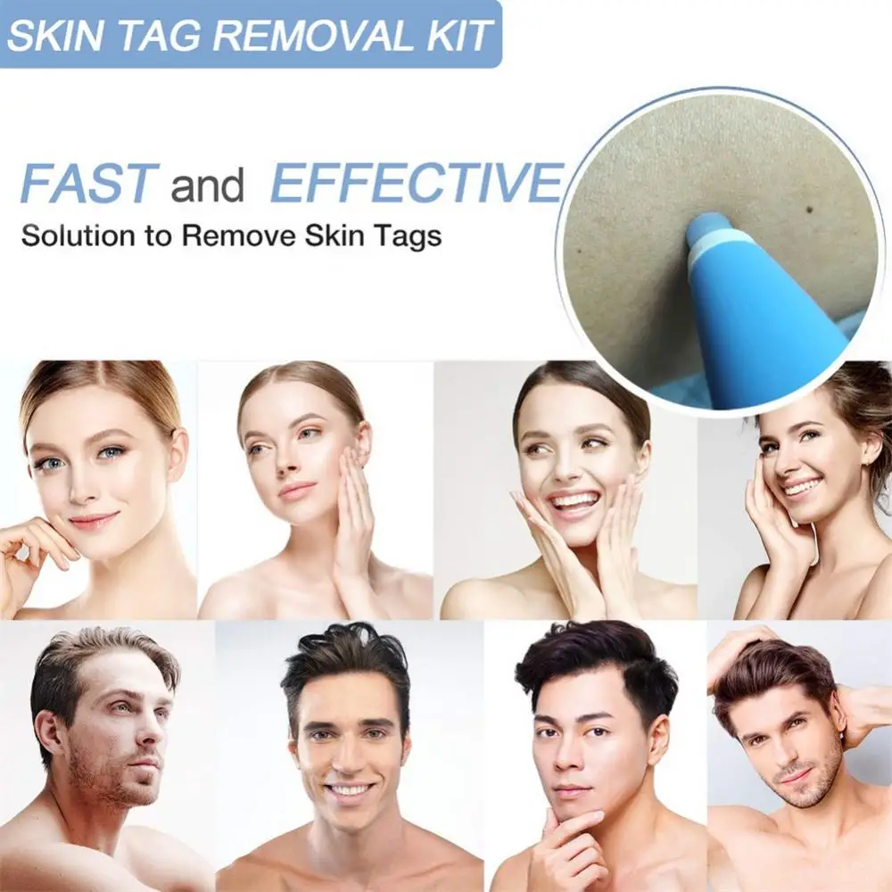 Skin Tag Removal Kit Easy To Use Advanced Gentle And Effective Mole Removal Cleansing Swabs Skin Tag Removal Revolutionary Safe