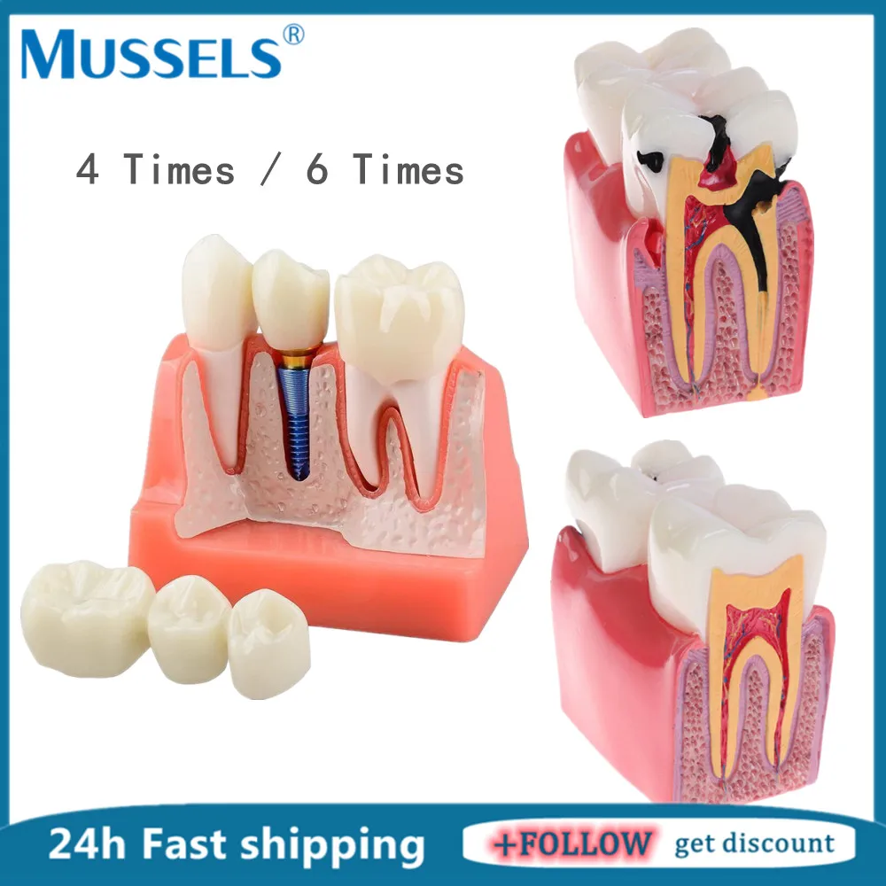 4 Times Implant Teeth Model Dental 6 Times Caries Comparation Study Models Removable Crown Bridge Teaching Demonstration Lab