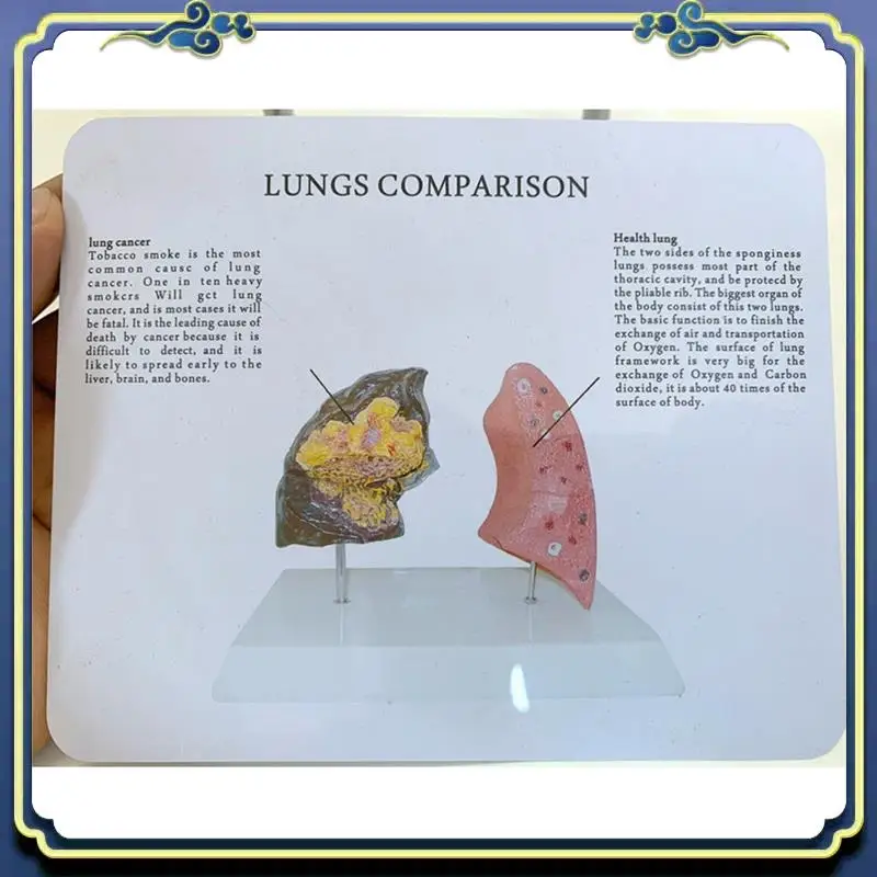 

Портативная модель легких курильщика. Модель здорового легкого со заболеваниями патологической дыхательной системы.