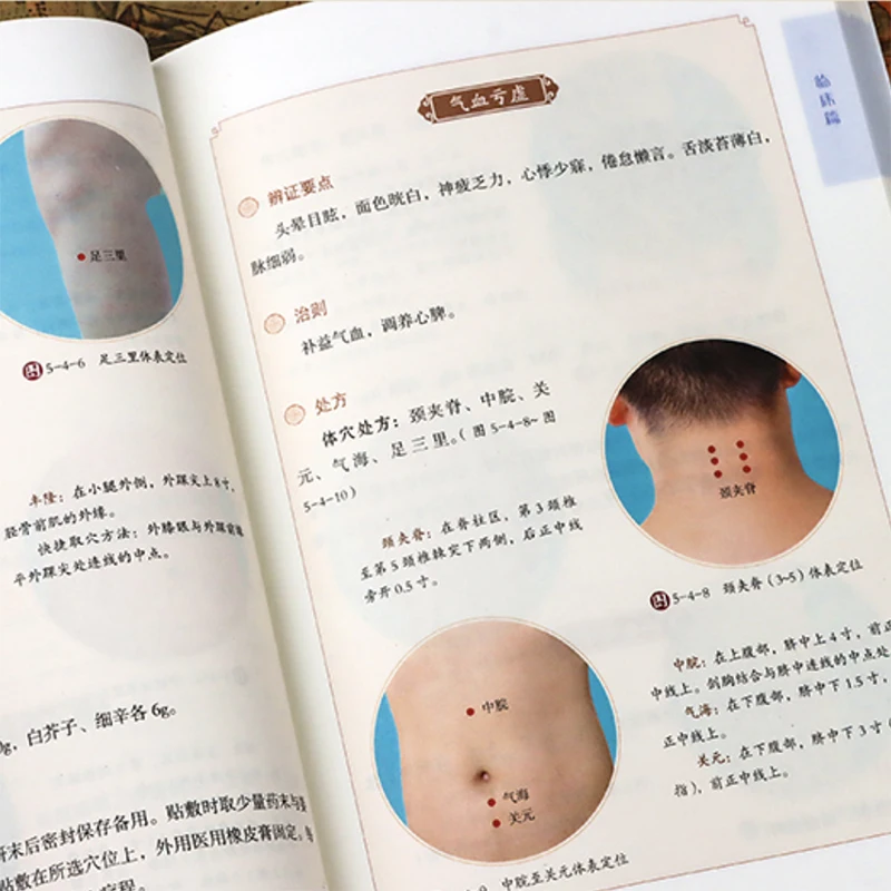 Catgut-terapia de incrustación de acupuntura gráfica, serie de libros de operación de medicina tradicional china, tecnología práctica para el