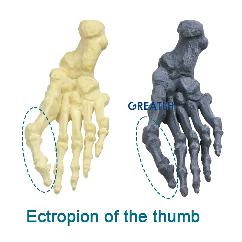 Medical Thumb Ectropion Model Hallux Valgus Correction Model Cortical Bone Foam/cancellous Cartilage Model