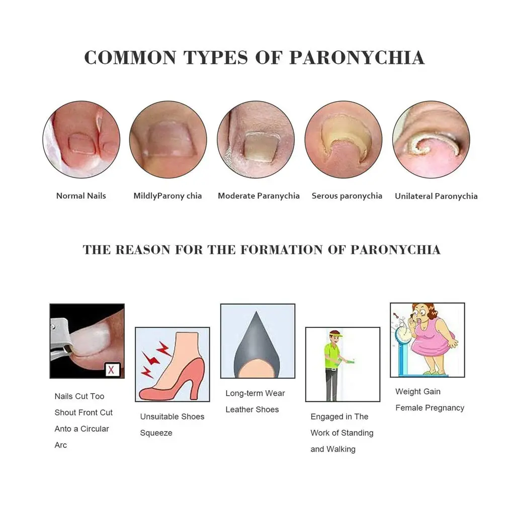 Correcteur d'ongles incarnés, outil de redressage des ongles des orteils réutilisable pour soulager la douleur, traitement fongique, soin Paronychia, outil de pédicure