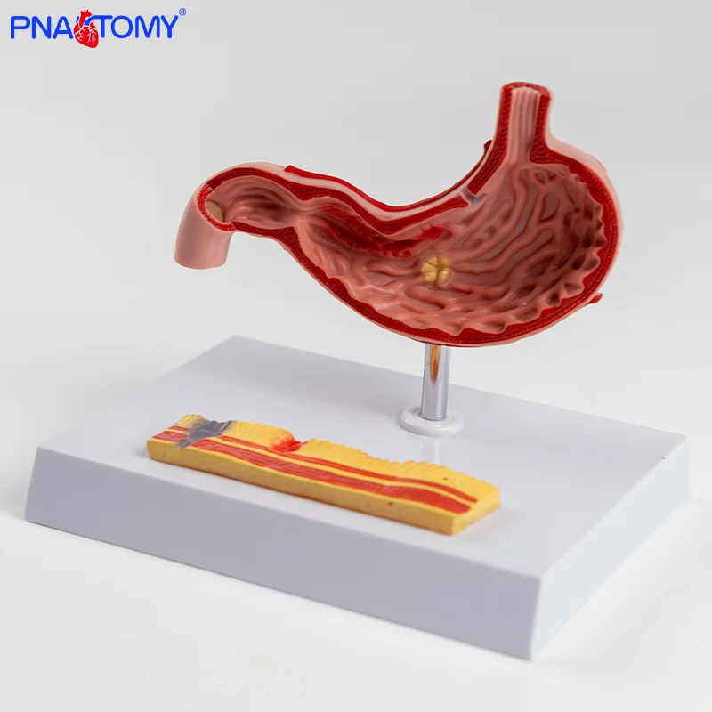 

Pathological Stomach Model Gastric Anatomical Pathology Model Digestive Department Digestive System Model