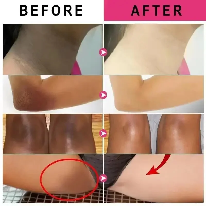 Whitening Cream Private Parts Underarm Bleaching Serum Whiten Butt Knee Brighten Inner Thigh Intimate Parts Dark Remove Melanin