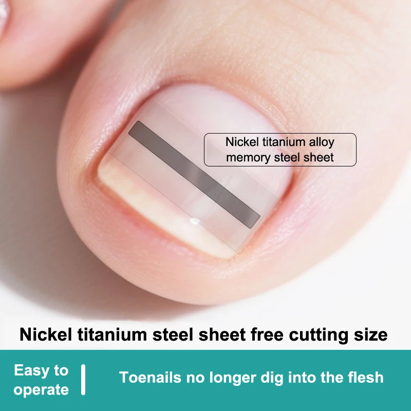 Strumento per la protezione delle dita dei piedi per la correzione dell'unghia del piede incarnita Adesivo per il trattamento delle unghie Strumento per pedicure della paronichia