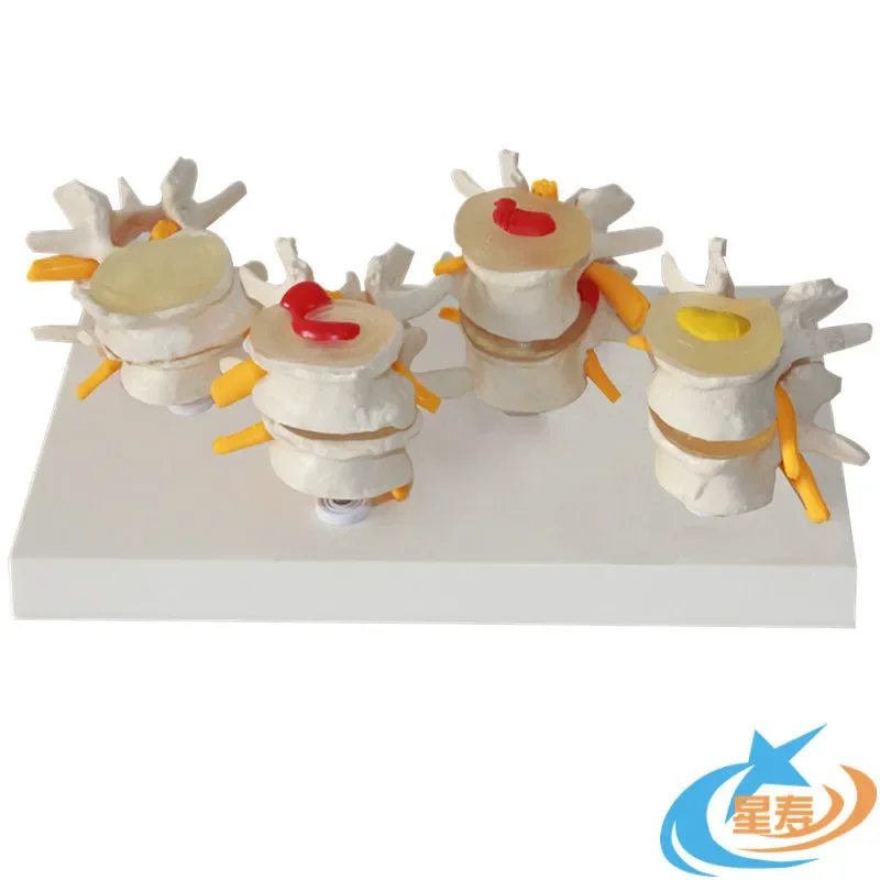 

Четырехступенчатая модель поясничного поражения, модель грыжи межпозвонкового диска, модель поясничного отдела, модель позвоночника