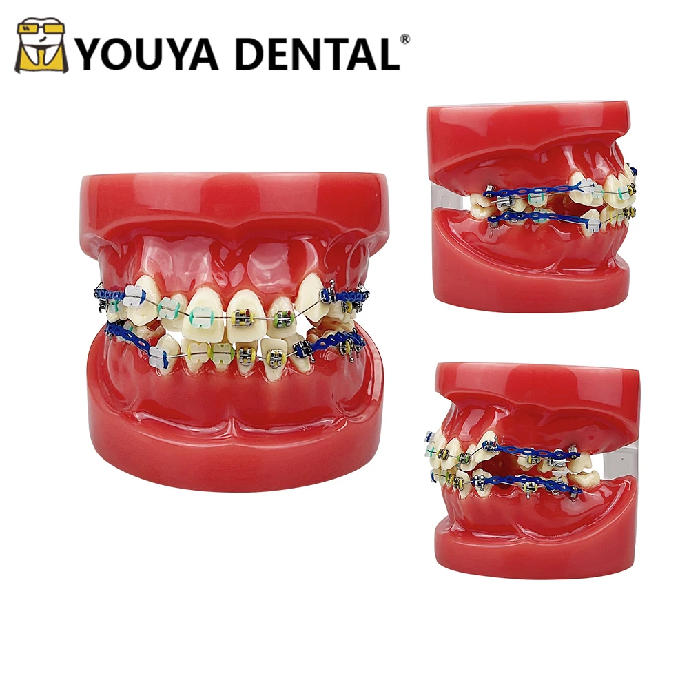 Dental Orthodontic Teaching Model Half Ceramic Half Metal Bracket Teeth Malocclusion Model for Dentist Technician Practice Study