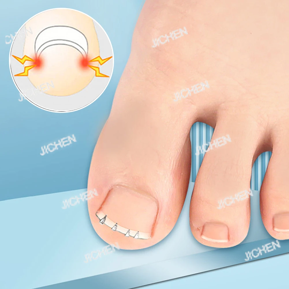 

Neu Ingrown Toenail Corrector Tool Embed Toe Nail Care Ingrown Toenail Correction Foot Care Tool Ingrown Toenail Pedicure Tool