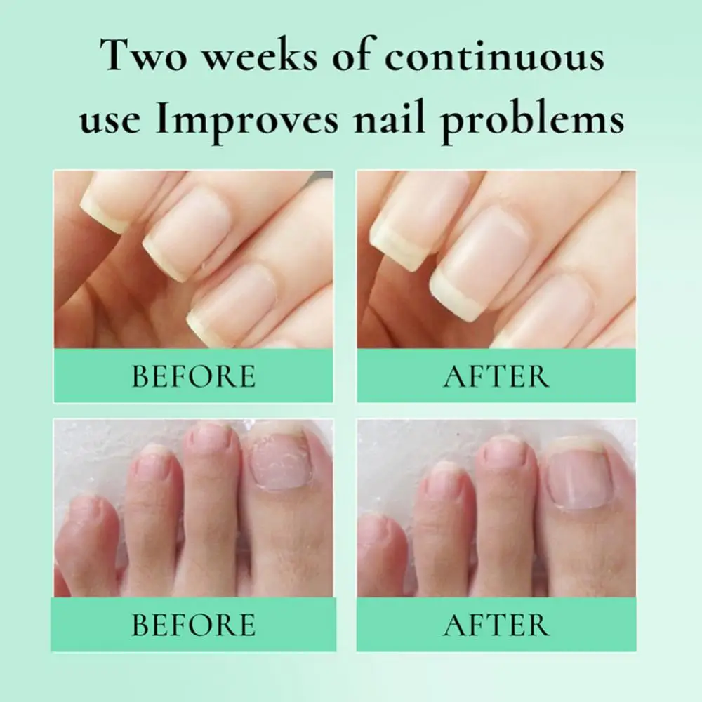 Aceite de Nutrición de uñas revitalizante, reparador nutritivo, cutículas nutridas, fortalece las uñas hermosas, hidrata las cutículas