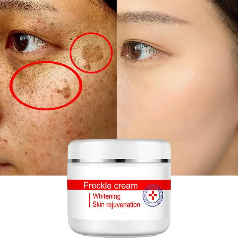 

Whitening Freckle Face Cream Remove Melasma Fade Dark Spots Melanin PigmentationRemover Brighten Skin Anti-Aging Skin Lightening