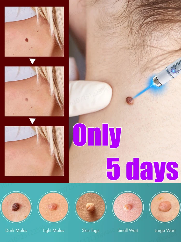 

Say Goodbye to Warts in 5 Days - Technology Changes Lives