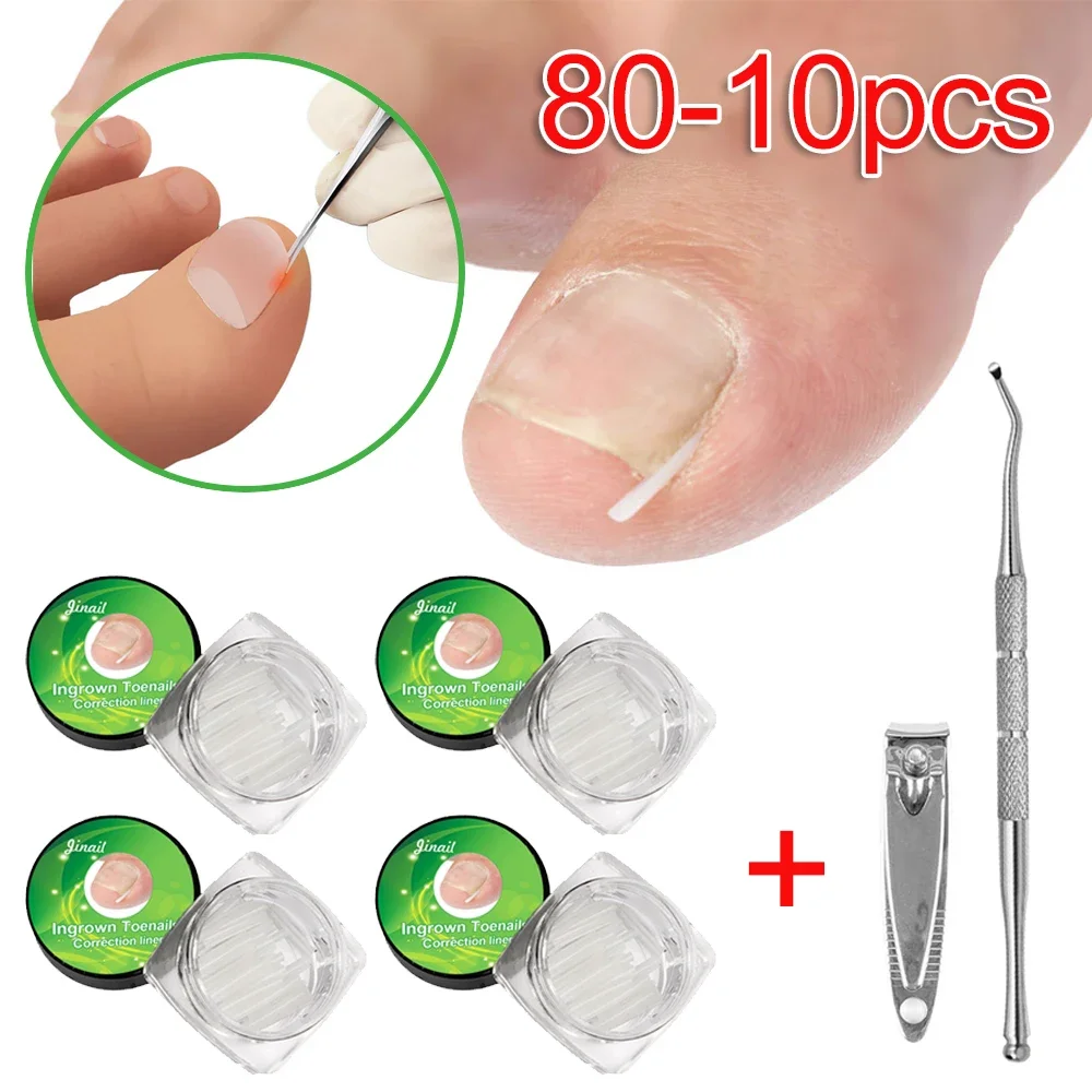 80-10 個陥入爪矯正ツール陥入爪治療弾性パッチステッカー矯正クリップブレースペディキュアツール