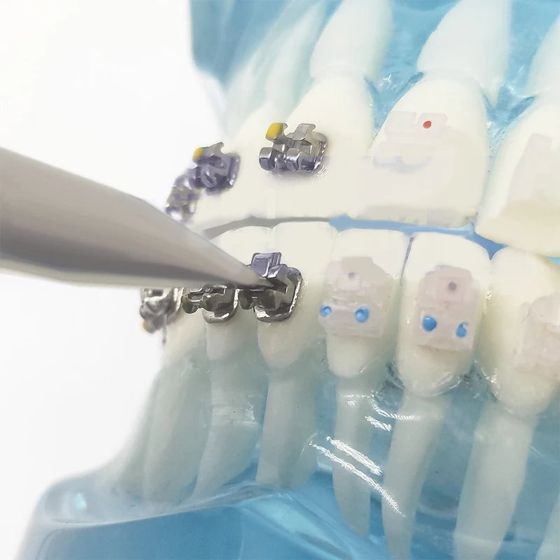 Abridor dental do aço inoxidável para o cuidado oral, auto-ligante, suporte passivo, cinta para a abertura ortodôntica