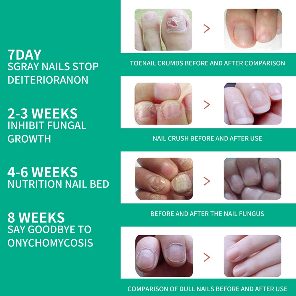 Extra forte tratamento de fungos nas unhas soro essência óleo pés reparação de unhas cuidados essência creme anti infecção dedo do pé remoção de fungos gel