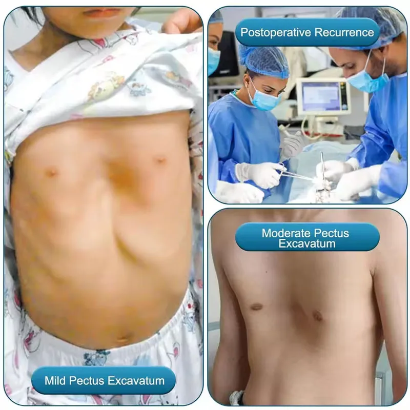 Pectus Excavatum Vacuum Bell,Pectus Excavatum Orthosis Brace,Sternal Depression Support Sunken Chest-Physical Chest Correction