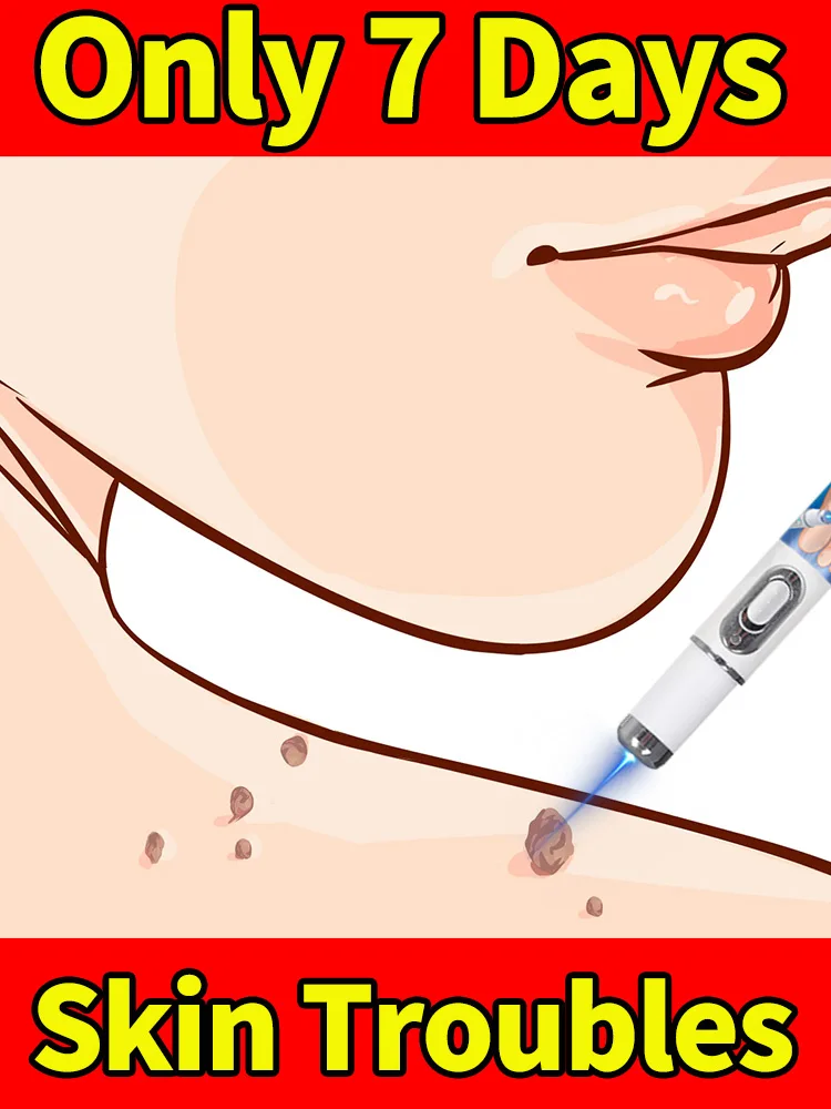 

Quick Wart Removal Laser Pen Stubborn Warts Remove Hot Sale Wart Care Tools