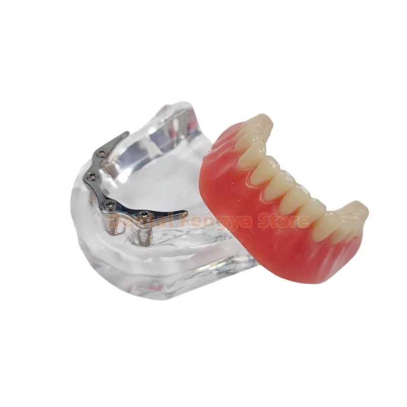 1 Pcs Dental With 4 Implants Overdenture Restoration Teeth Model With Silver/Gold Connecting Rod Dentist Teaching Demo Typodont