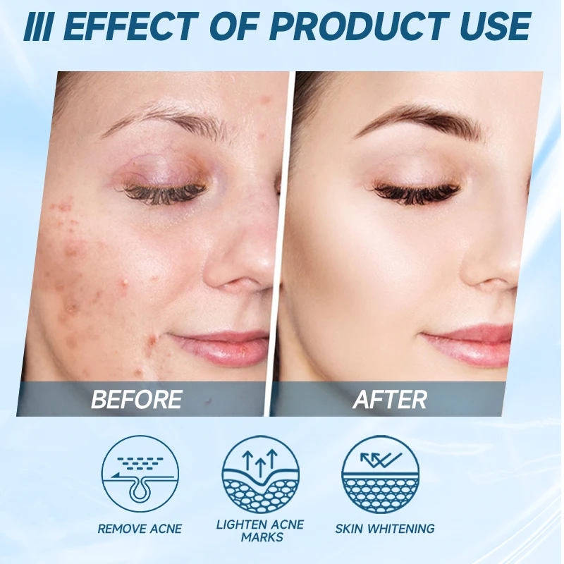 Afcare Acne Treatment Removal Serum 100% EGF Natural Essence Repair Skin Efficiency Clearing Severe Acne Brightening Skin