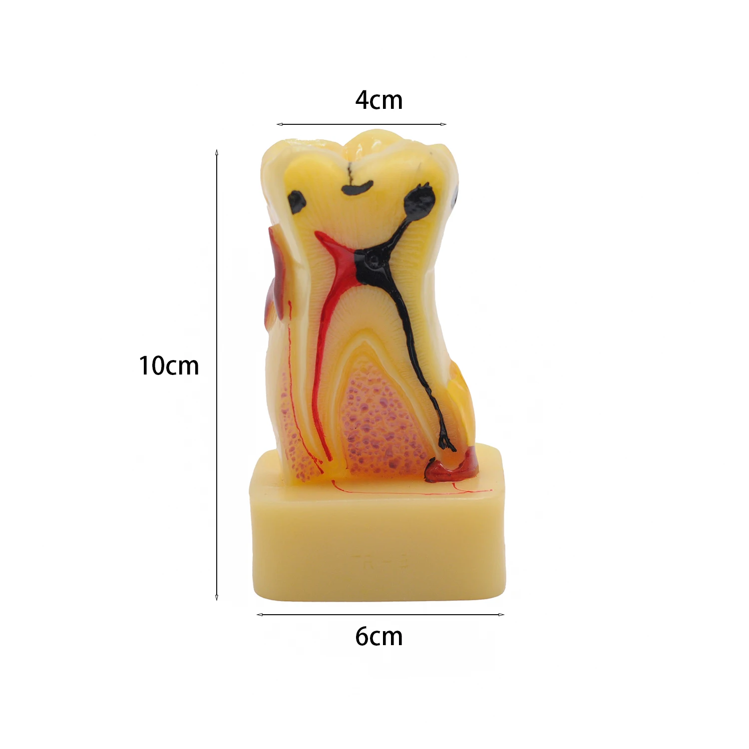 1pc Dental Teaching 4 Times Tooth Pathology Teeth Comprehensive Periodontal Model