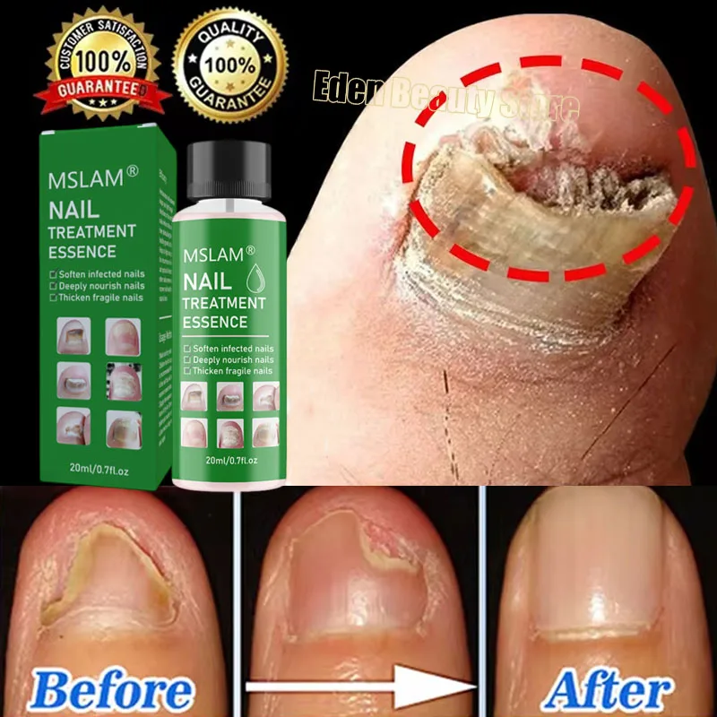 

7-дневная сыворотка для лечения грибка ногтей, восстанавливающая эссенция для удаления грибка ногтей на ногах, против инфекции, паронихии, онихомикоза, уход за здоровьем