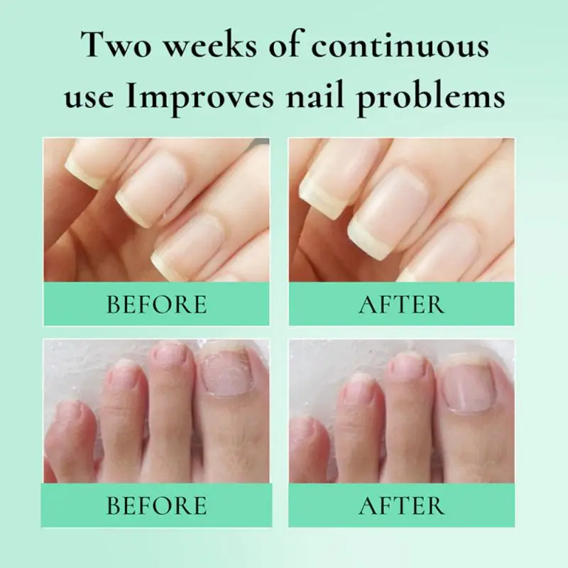 Cuticle Remover Repairing Eliminates Nail Fungus Nail Health Beautiful Nails Nourishment Strengthening Nail Care Hydrating