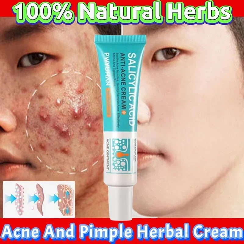 Salicylic Acid Acne Removal Face Cream Acne Treatment Anti Pimples Spots Gel Repair Scars Pores Shrinking Oil Control Skin Care