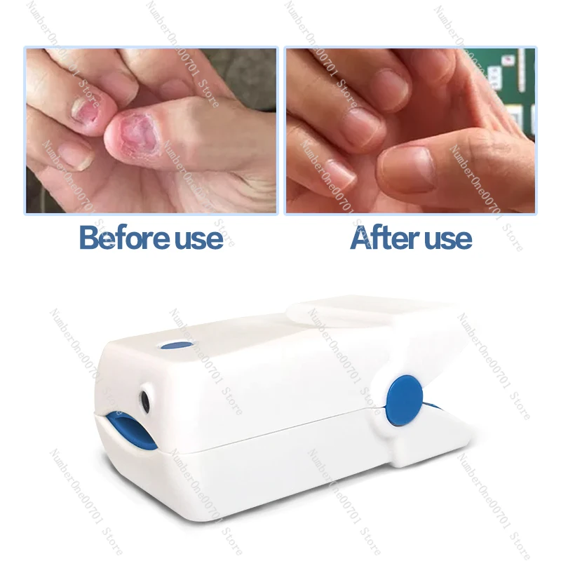 Wholesale Home Use Laser for Toe Nail Fungus Treatment Anti Infection Therapy Foot Toenail Fungal Cleaning Repair Physiotherapy