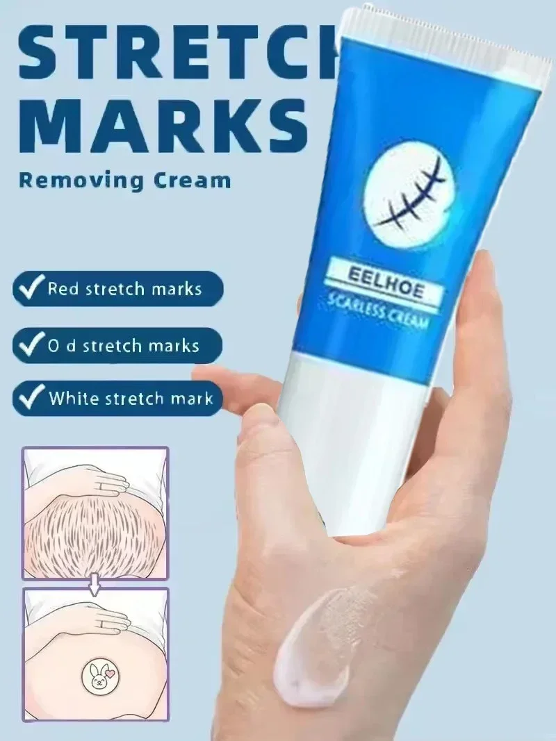 Eliminate Red White Old Stretch Marks Cream For Pregnancy Postpartum Skin Care