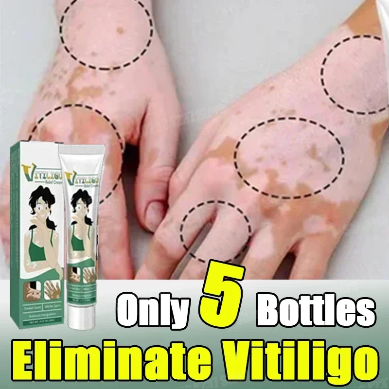 

Eliminate Vitiligo cream Skin soothing White Spot Removal vitiligo ointment Eliminate pigment