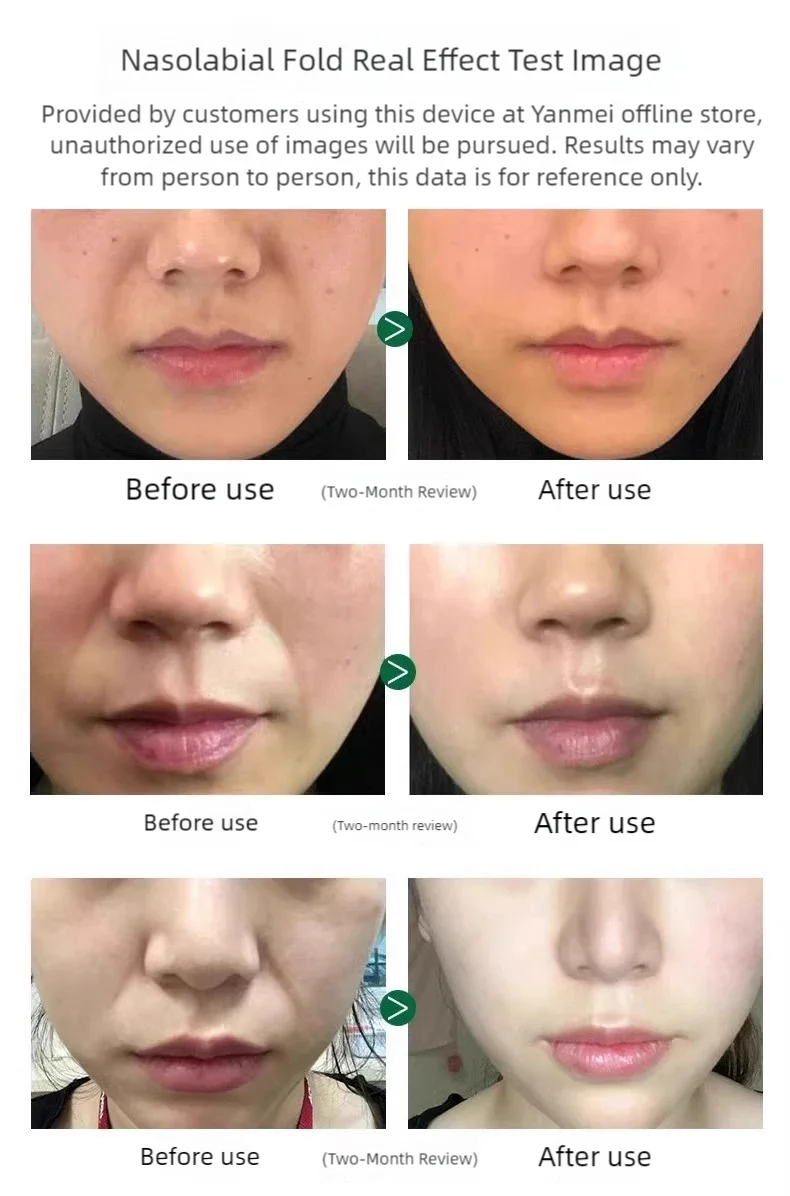 جهاز تجميل بالموجات فوق الصوتية متعدد الوظائف بتردد الراديو، تجديد البشرة الخفيفة، جهاز مضاد للشيخوخة مكركرنت، يحسن الصلابة، يقلل من التجاعيد، ويعزز امتصاص منتجات العناية بالبشرة #2