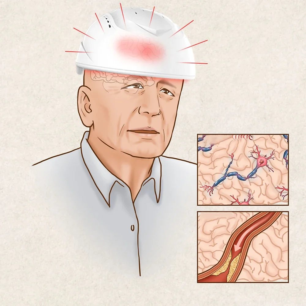 Infrared 810nm Laser Helmets Neuro Feedback Eeg Therapy Machine Pdt Pbm Brain Infrared Therapy Devicephotobiomodulation Helmet