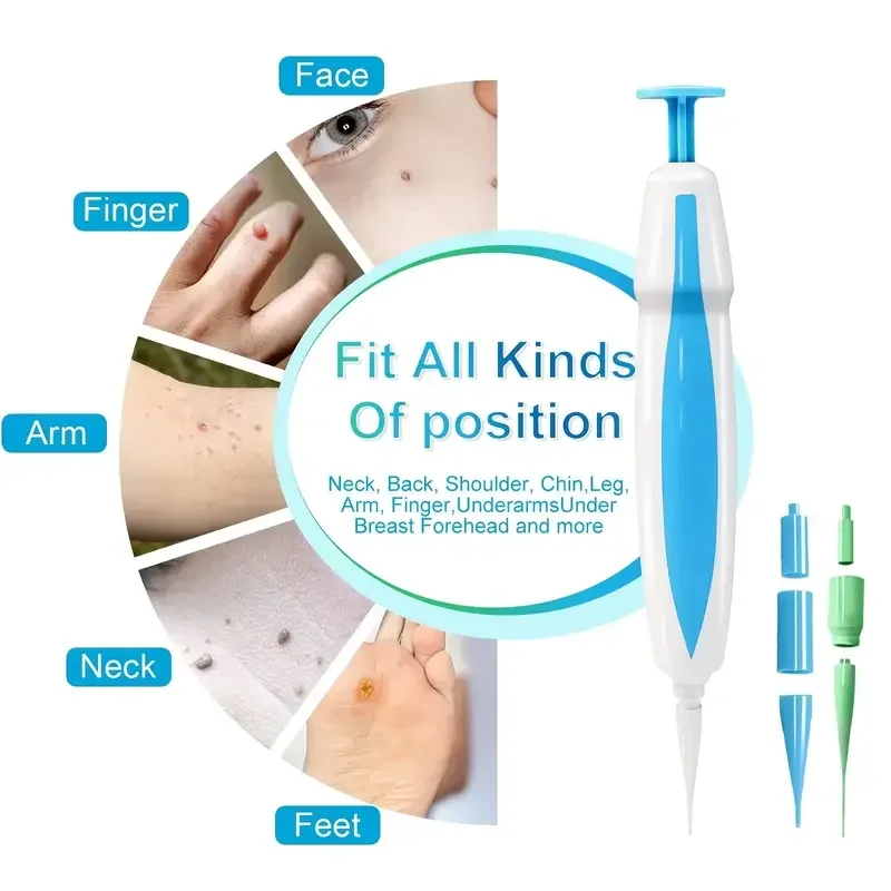 Body Wart Dot Behandelingen Remover Schoonheid Gezondheid 3 In 1 Pijnloos Auto Skin Tag Mol Wrattenverwijdering Kit Reinigingsgereedschap Gezicht Huidverzorging