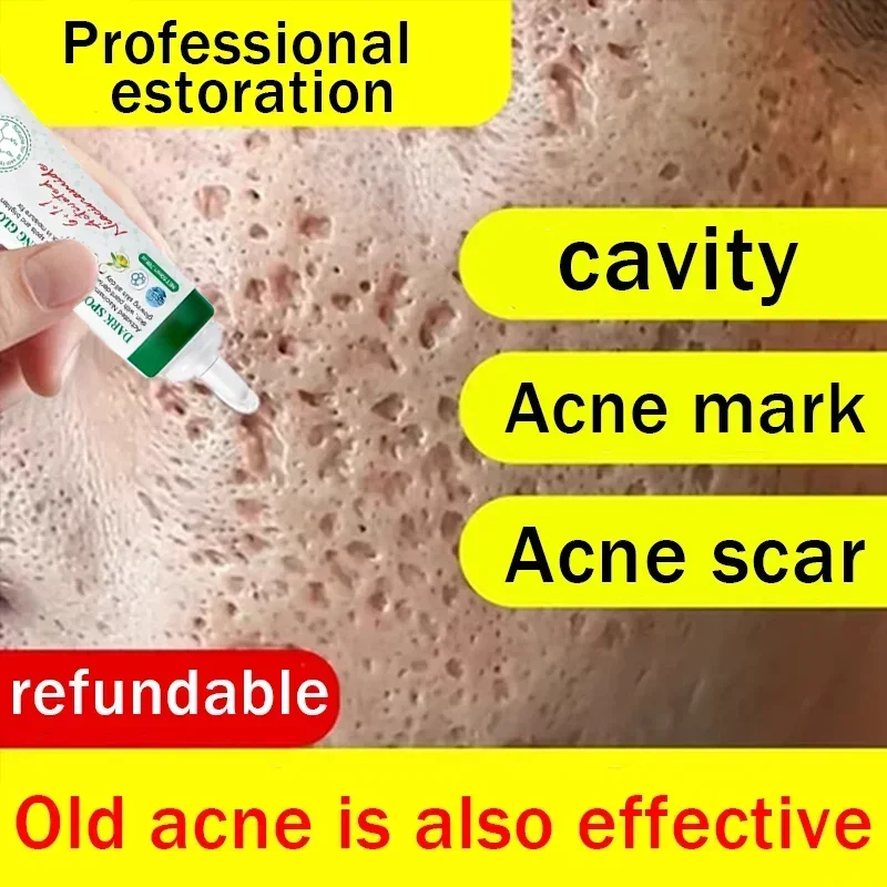 

Anti-acne mark pothole Repair Men's Hole Repair Cream Fade to remove acne mark scar fade fill regeneration gel