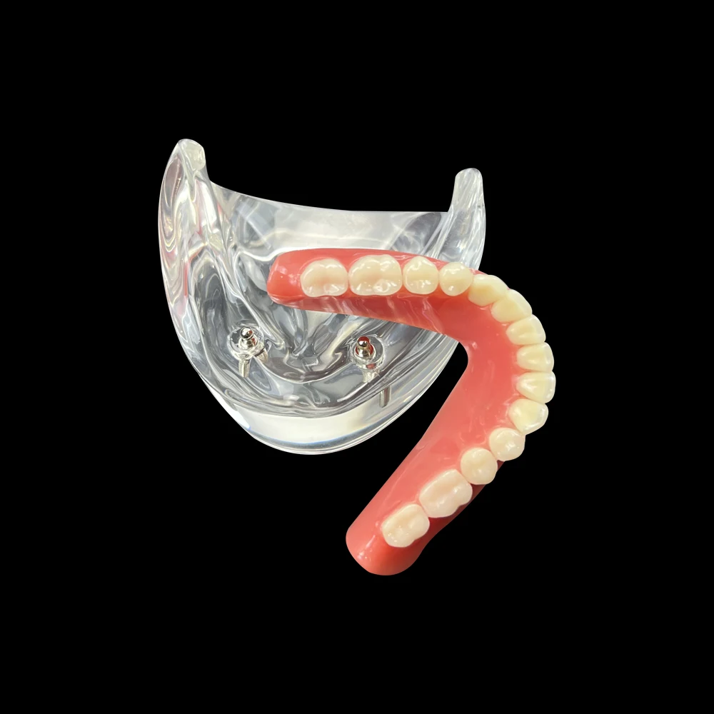 Dental Overdenture Teeth Model 2 Implants Demo Model 6002 Removable Restoration Dentist Student Learning Lower Model