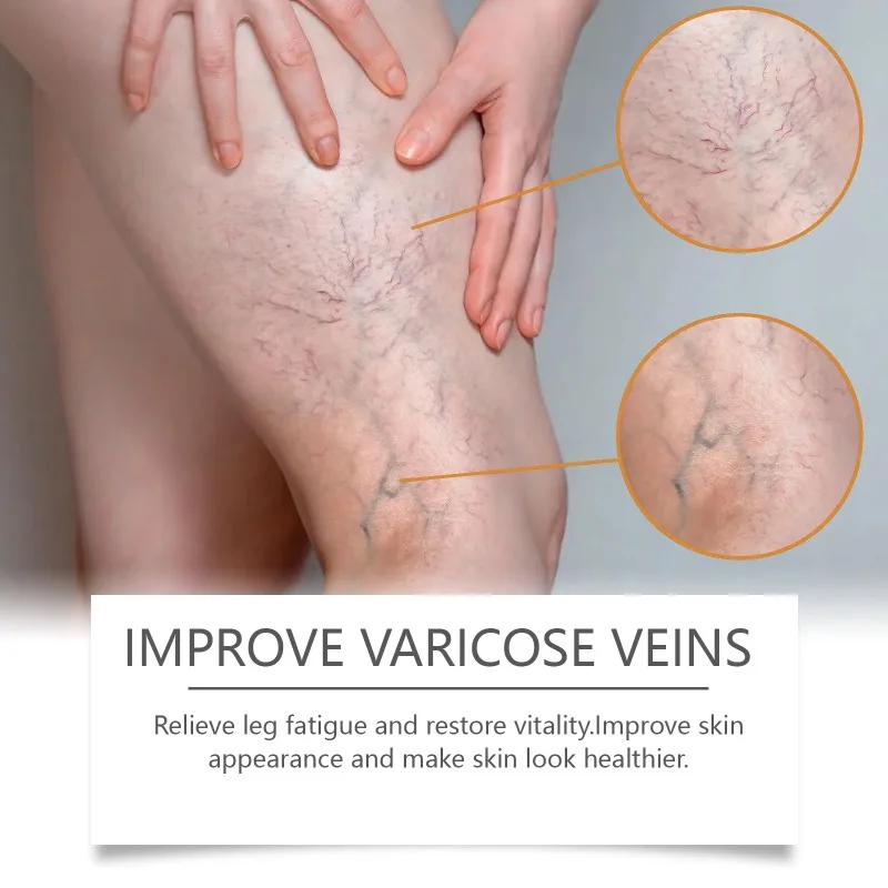 Varizes Eliminar Pernas De Aranha, Veia De Aranha, Aliviar Vasculite, Flebite, Massagem Pernas, Tratamento Da Dor, Varizes