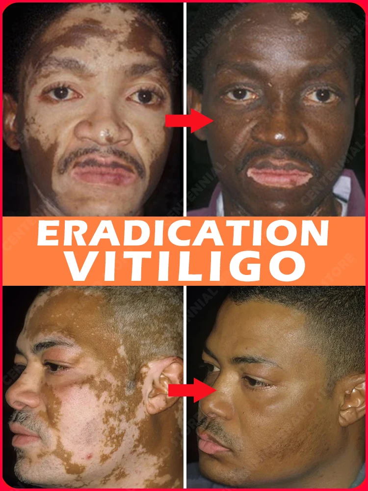 Rapid Improvement of Vitiligo